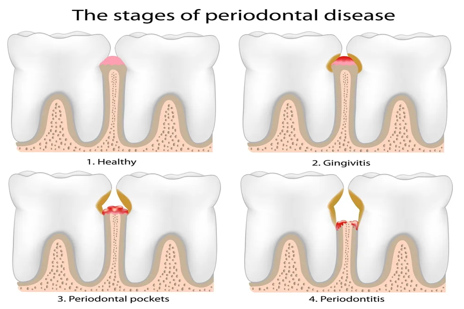 Signs & Symptoms of Periodontal Disease