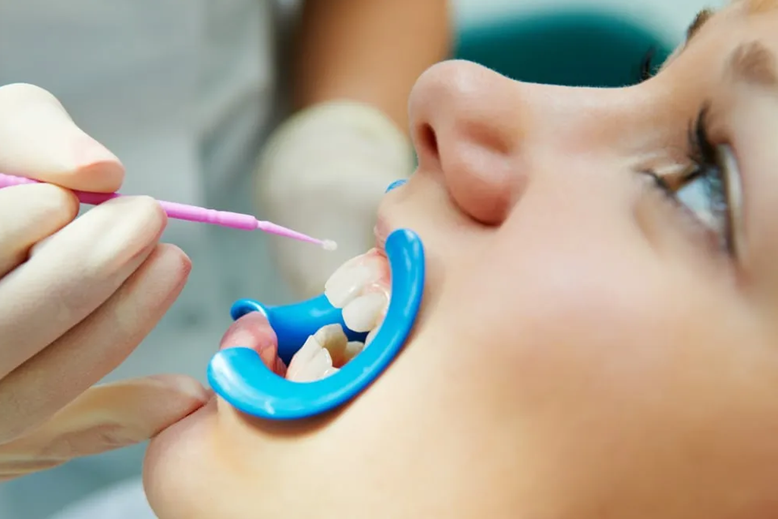 pediatric dental sealants